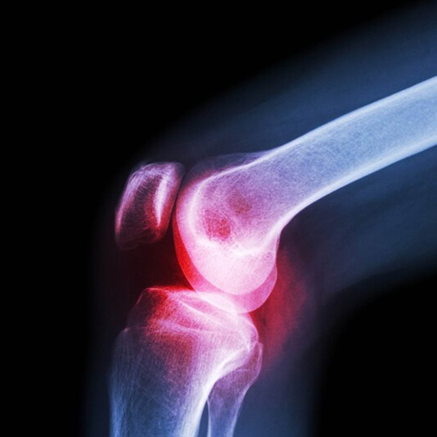 6233 (Xl) Knee Cap For Knee Support - 9XShoppy